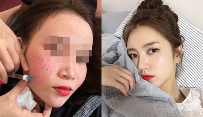 “Cấy” tinh chất DNA cá hồi, lăn kim có thực sự làm đẹp da an toàn như vẫn tưởng? “Cấy” tinh chất DNA cá hồi, lăn kim có thực sự làm đẹp da an toàn như vẫn tưởng?