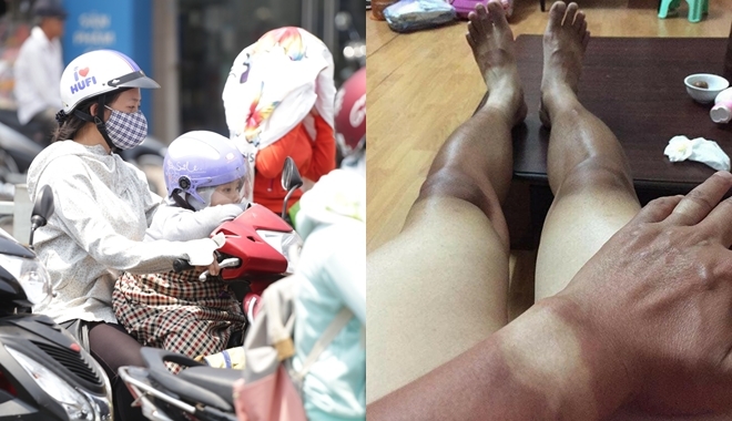 Tia UV ở mức cao báo động, cần làm gì để bảo vệ da và mắt khỏi nguy cơ cháy nắng, ung thư? Tia UV ở mức cao báo động, cần làm gì để bảo vệ da và mắt khỏi nguy cơ cháy nắng, ung thư?