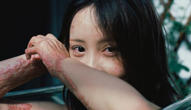 Bị thiêu sống năm 16 tuổi, cô gái vẫn mạnh mẽ chiến đấu với những vết sẹo chằng chịt Bị thiêu sống năm 16 tuổi, cô gái vẫn mạnh mẽ chiến đấu với những vết sẹo chằng chịt