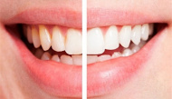 7 thực phẩm làm thay đổi màu răng bạn