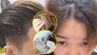 "Đua đòi" nhuộm tóc bằng oxy già: Lợi bất cập hại, dễ kích ứng
