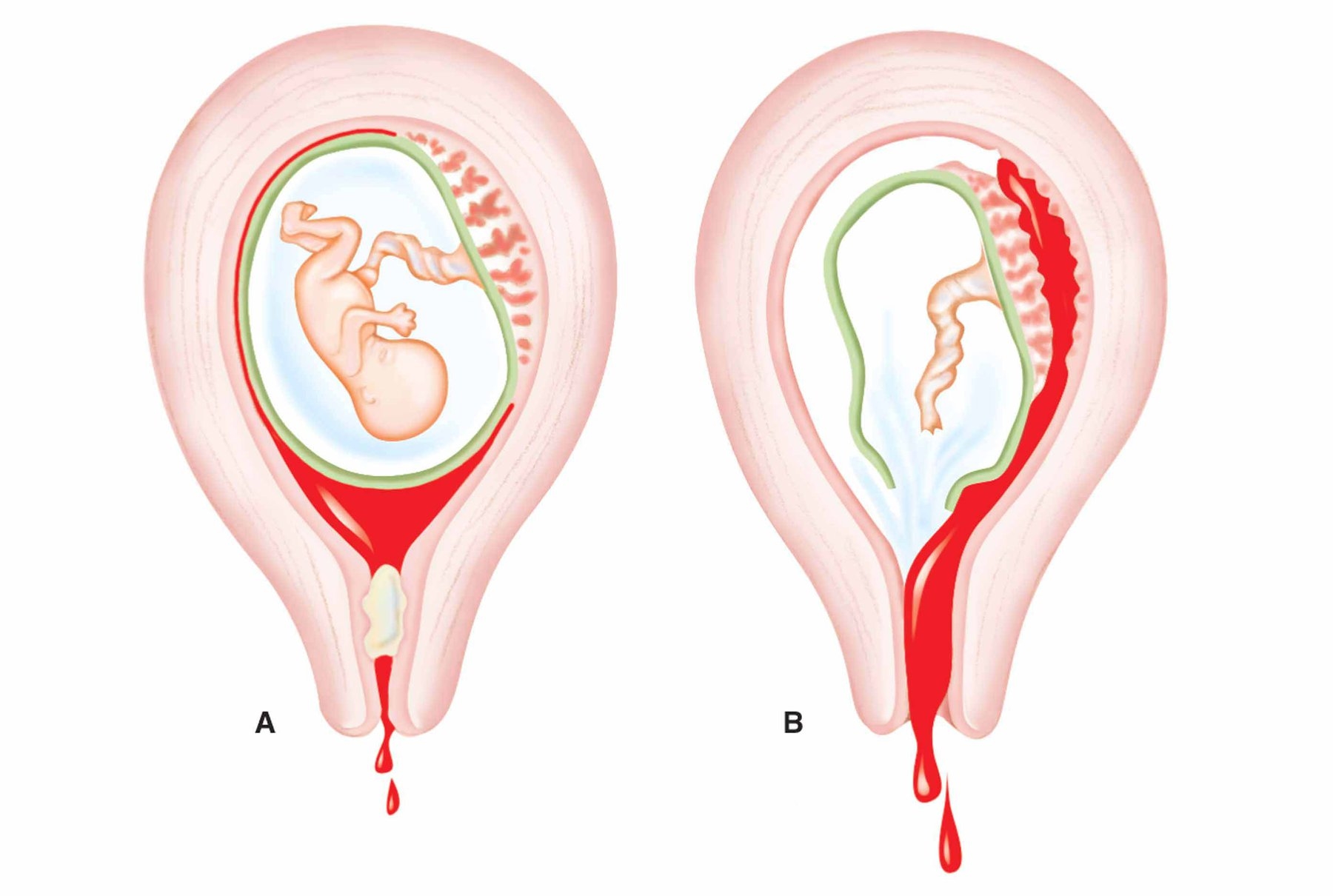 Прерывание беременности 3 недели. Гипертонус шейки матки при беременности. Неполный самопроизвольный выкидыш. Неполный медикаментозный выкидыш.