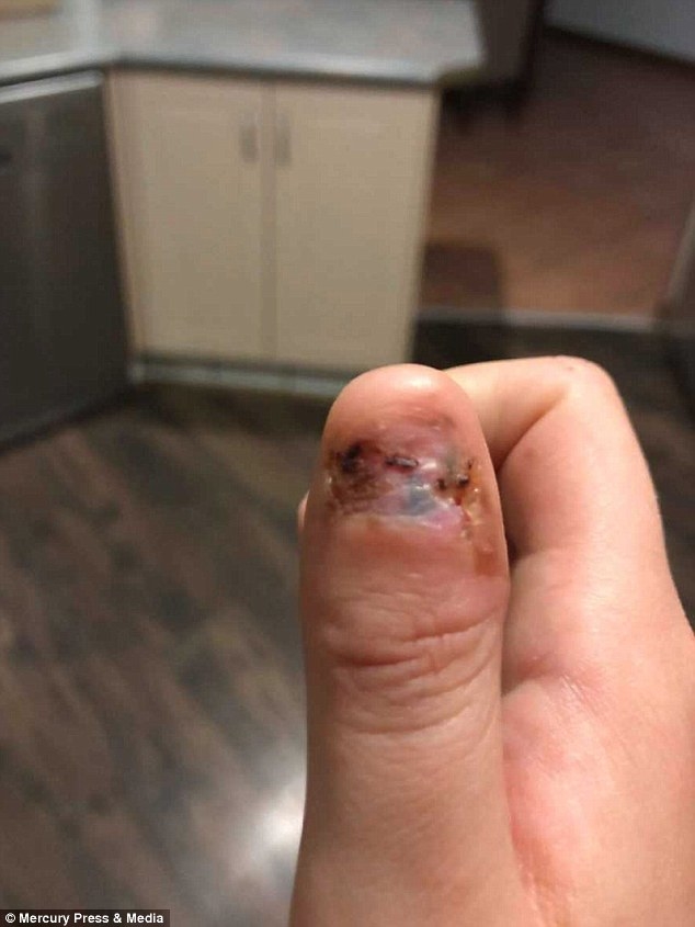 Nữ sinh phải phẫu thuật cắt bỏ ngón cái do thói quen “cắn móng tay