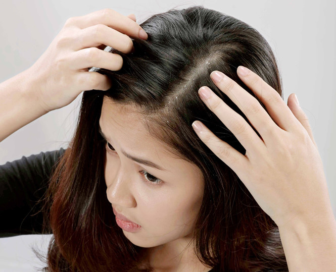 Những bất thường ở mái tóc cảnh báo sức khỏe có vấn đề