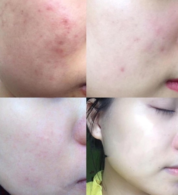 Đánh bay sach mụn cám chỉ nhờ tối giản các bước chăm sóc da