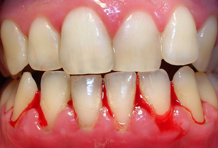 Những triệu chứng răng miệng bất thường tuyệt đối không được lơ là