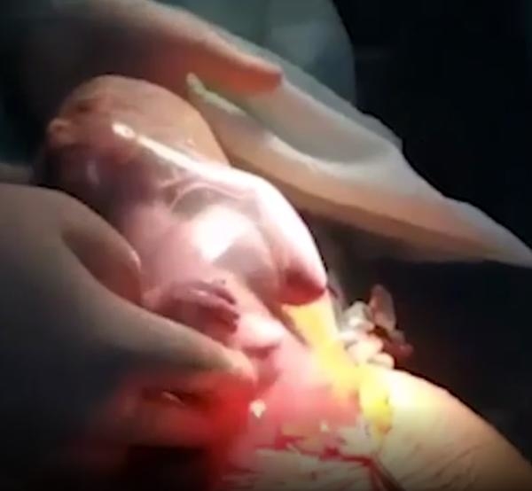 Ngắm khoảnh khắc kì diệu khi em bé ngọ nguậy, cố sức ra khỏi túi ối