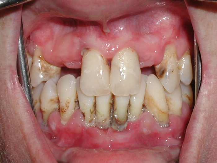 Cô gái phải nhổ cả hàm trên vì quên một việc khi vệ sinh răng