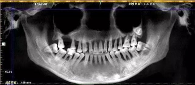 Cô gái phải nhổ cả hàm trên vì quên một việc khi vệ sinh răng