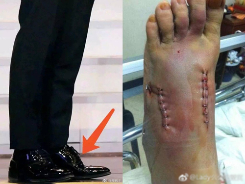 Bị soi đi giày độn tăng chiều cao, Huỳnh Hiểu Minh khiến CĐM xót xa