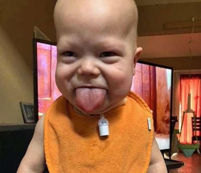 Siêu âm thấy con thè lưỡi đáng yêu nhưng đó lại bệnh hiếm gặp