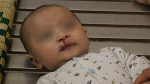 Siêu âm thấy con bị hở hàm ếch, mẹ chết đứng nghe bác sĩ chỉ đích danh mình là “thủ phạm” hại con ra nông nỗi này - Ảnh 3. Chỉ vì mắc sai lầm đơn giản mẹ bầu chết lặng khi con bị hở hàm ếch