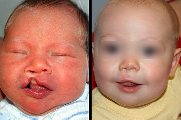 sứt môi hở hàm ếch có thể chữa được