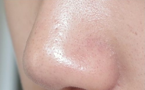 Cách đánh bay mụn cám trong vòng một nốt nhạc