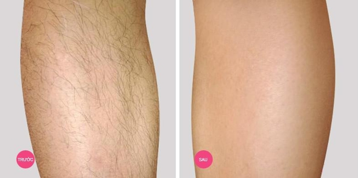 Cách triệt lông tay chân hiệu quả giúp bạn gái tự tin diện váy xinh