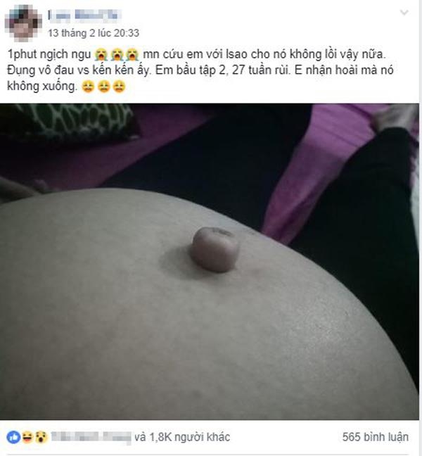 Mẹ bầu cầu cứu cộng đồng mạng vì ngứa tay nghịch dại làm rốn lồi 1 cục