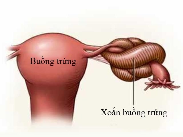 Đau bụng dữ dội cô gái trẻ tá hỏa khi biết bị xoắn buồng trứng