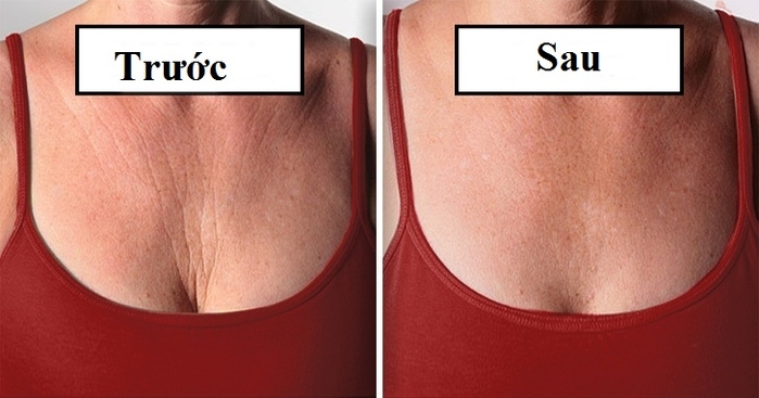 Những cách xóa nếp nhăn vùng ngực khiến chị em tự tin