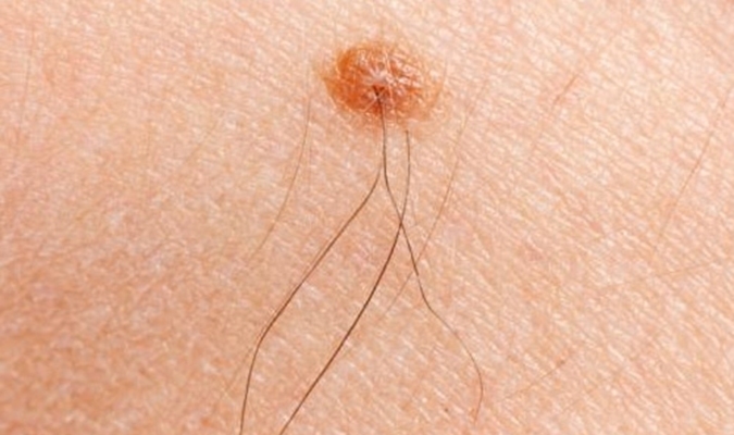 Lông mọc ở 7 vị trí này trên cơ thể tài lộc ào ào đến