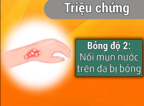 Những cách xử lí kịp thời khi bé bị bỏng mà ba mẹ cần khắc cốt ghi tâm Những cách xử lí kịp thời khi bé bị bỏng mà ba mẹ cần khắc cốt ghi tâm