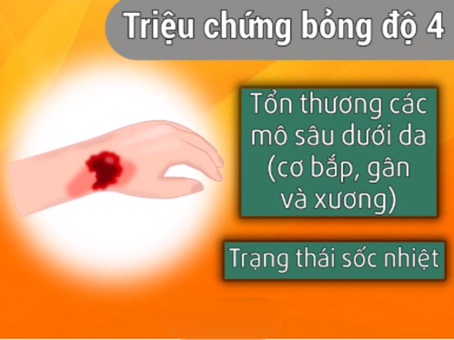 Những cách xử lí kịp thời khi bé bị bỏng mà ba mẹ cần khắc cốt ghi tâm Những cách xử lí kịp thời khi bé bị bỏng mà ba mẹ cần khắc cốt ghi tâm