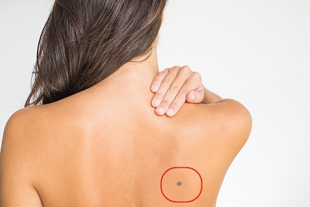 6 vị trí nốt ruồi phú quý trên lưng của phụ nữ, chớ dại mà xóa bỏ