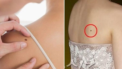 6 vị trí nốt ruồi phú quý trên lưng của phụ nữ, chớ dại mà xóa bỏ