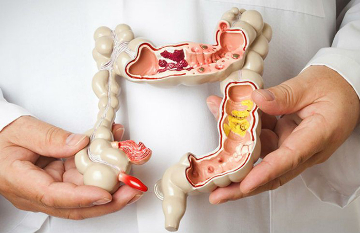 Bác sĩ 38 tuổi bị ung thư ruột giai đoạn cuối chỉ vì lơ là