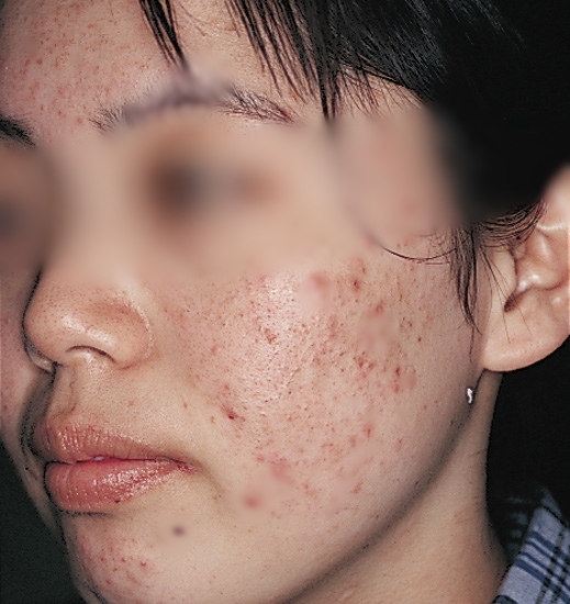Cô gái trẻ “rước mụn lên mặt” vì lạm dụng việc xông mặt bằng chanh sả