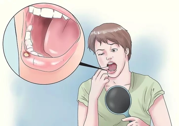 Có nỗi đau nào hơn thất tình không thì đó chính là nhiệt miệng