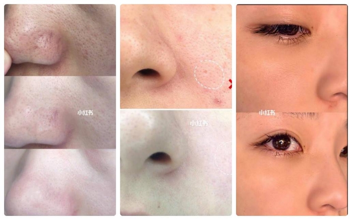Phương pháp chườm nóng giúp da trẻ trung hơn mỗi ngày