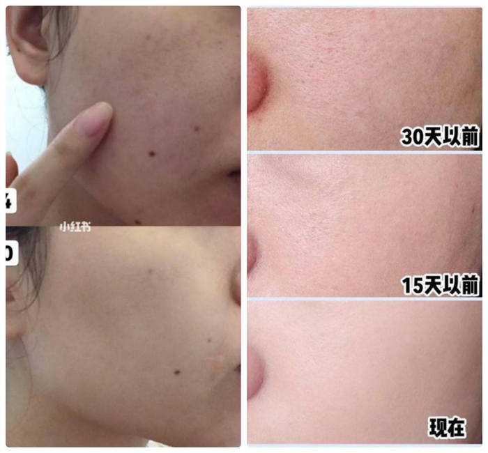Phương pháp chườm nóng giúp da trẻ trung hơn mỗi ngày