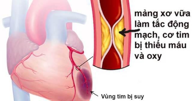 Lên cơn nhồi máu cơ tim khi đi cắm trại, nữ sinh lớp 7 tử vong