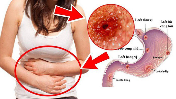 Người mẫu 8x qua đời vì ung thư dạ dày, chuyên gia khuyến cáo gì