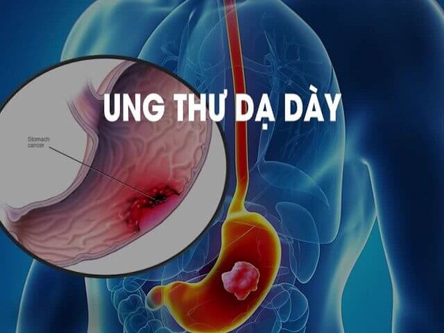 Người mẫu 8x qua đời vì ung thư dạ dày, chuyên gia khuyến cáo gì