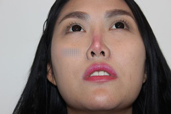Sao Việt và hành trình tìm lại nhan sắc sau PTTM hỏng