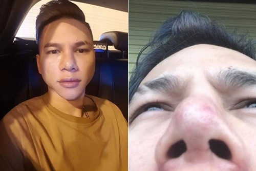 Sao Việt và hành trình tìm lại nhan sắc sau PTTM hỏng
