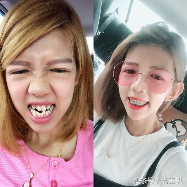 Những ca niềng răng giúp nhiều người lột xác