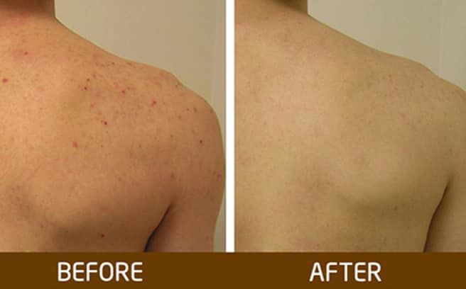Mụn lưng là nỗi khiếp sợ của chị em nhưng cách trị đơn giản lắm