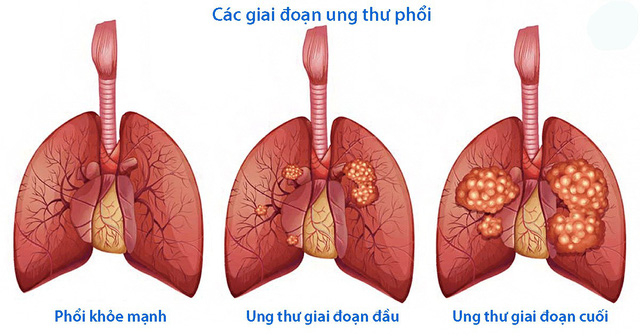 Nghệ sĩ Lê Bình qua đời vì ung thư phổi, di căn tới tủy