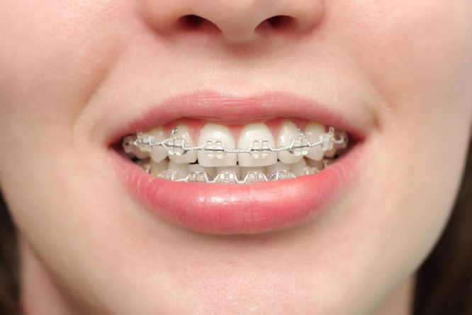 Những ca niềng răng giúp nhiều người lột xác
