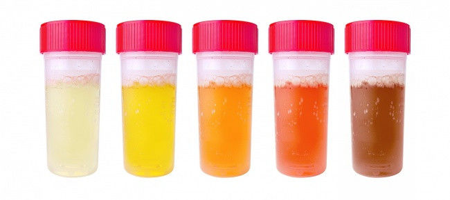 Những dấu hiệu cảnh báo thận của bạn đang có vấn đề
