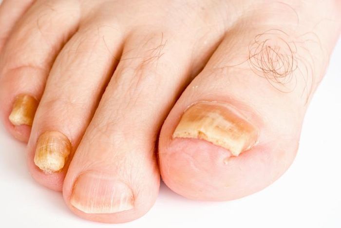 Những dấu hiệu trên bàn chân cảnh báo vấn đề về sức khỏe bạn nên biết