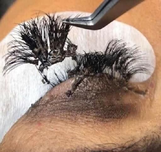 Rợn người với những hình ảnh nối mi hỏng: Bạn còn dám đi nối mi không?