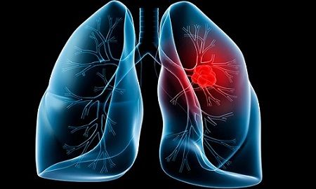 Cảnh báo nghề nghiệp gây tổn thương phổi khủng khiếp