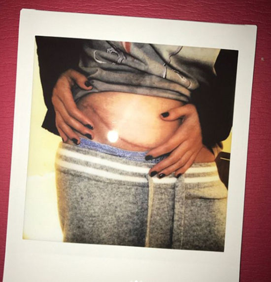 Body của Selena Gomez sau phẩu thuật ghép thận khiền fan xót