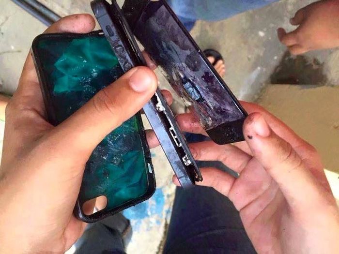 Thanh niên 22 tuổi mất bàn tay do điện thoại nổ khi đang sạc