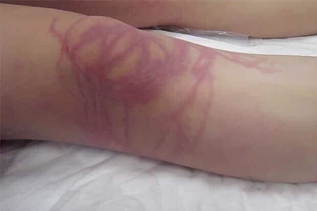 Tắm biển ngày hè: Cẩn trọng khi bị sứa đốt và cách xử lý hiệu quả