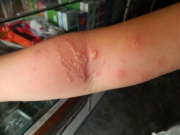 Tắm biển ngày hè: Cẩn trọng khi bị sứa đốt và cách xử lý hiệu quả
