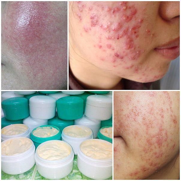 Hãi hùng trước những tác hại do kem trộn thần tốc mang lại